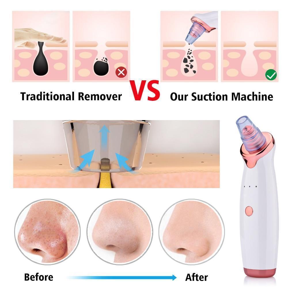 Power Suction Blackhead Cleaner