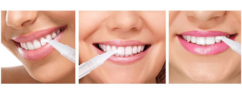 #1 Teeth Whitening Pen - Perfect Smile